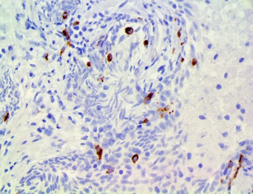 IHC of Langerin/CD207 on a FFPE Prostate Tissue